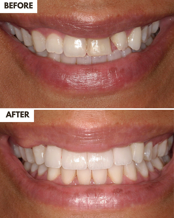 Veneers Case 2