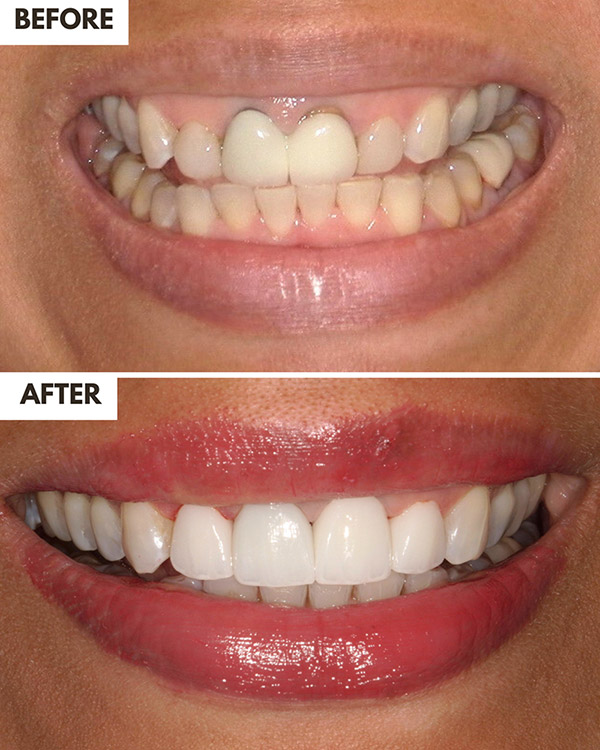Veneers Case 20