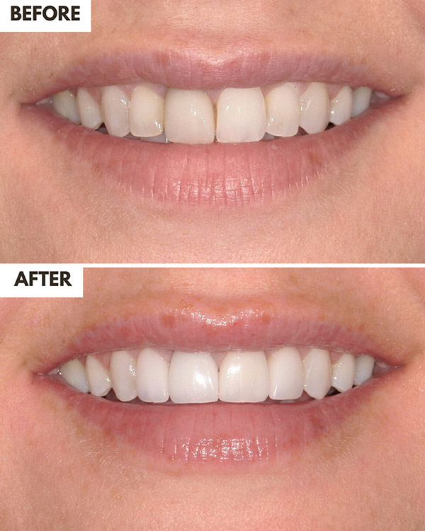Veneers Case 22