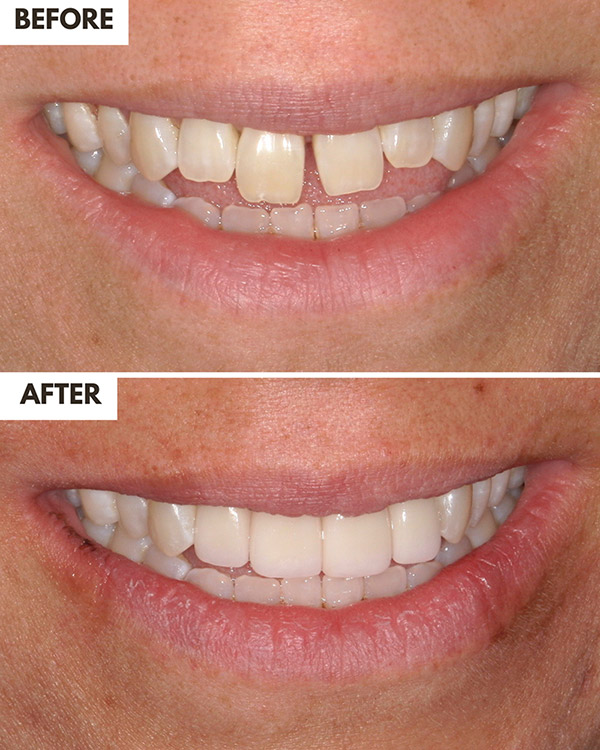 Veneers Case 26
