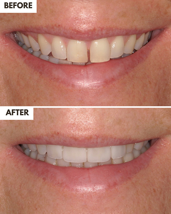Veneers Case 6