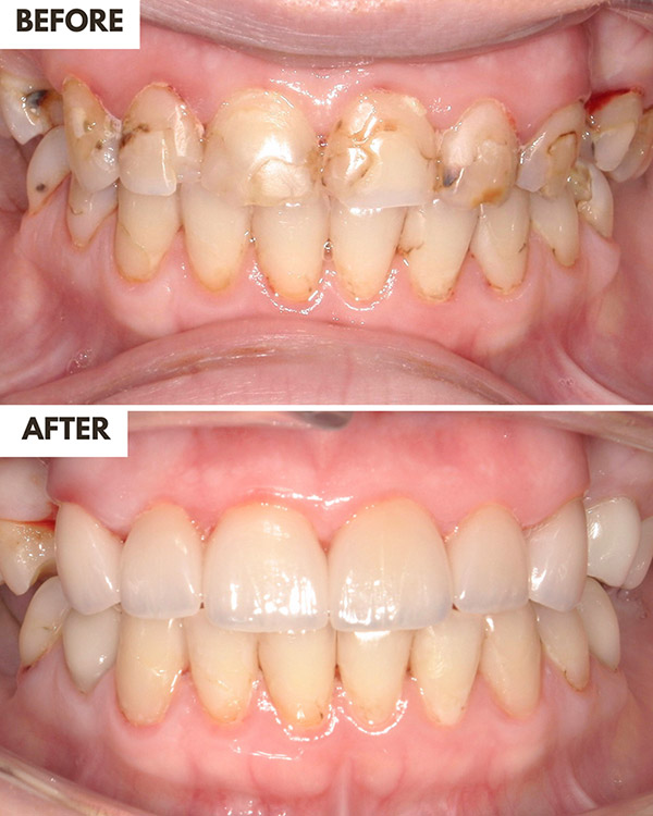 Veneers and Crowns Case 9