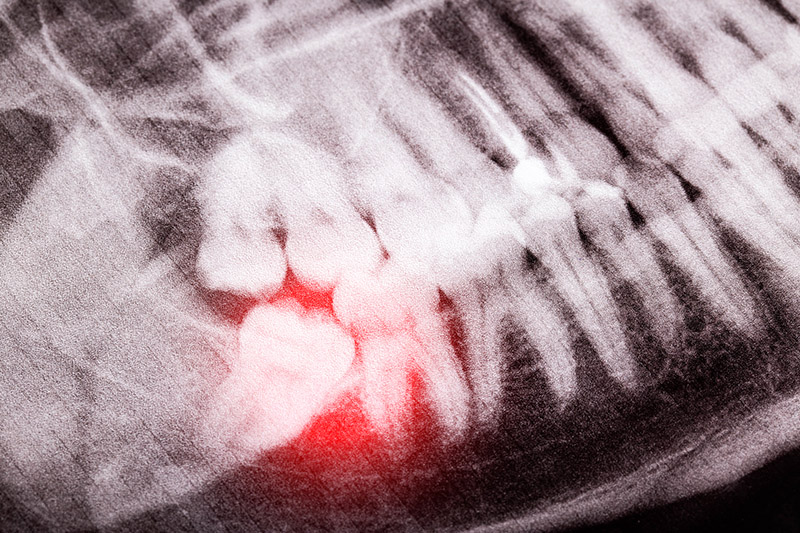 Implant Dentures/All-on-X in Maspeth