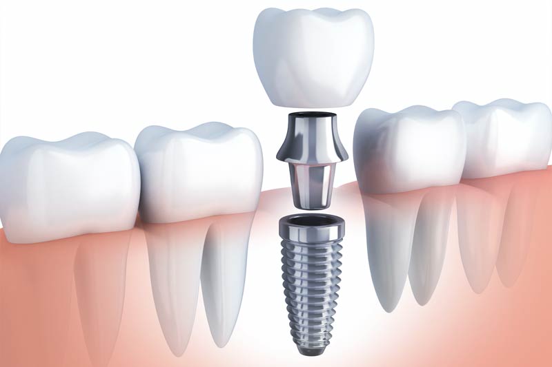 Implants Dentist in Maspeth
