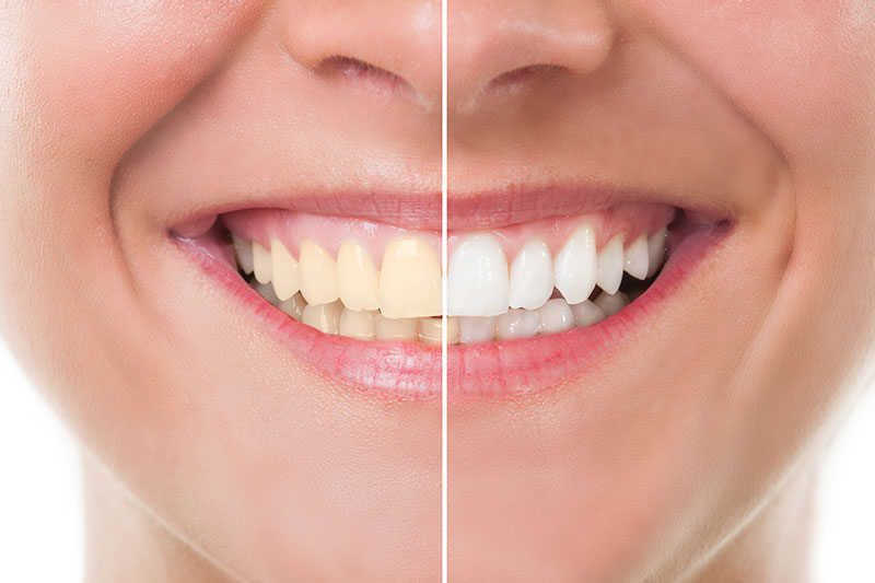 Teeth Whitening in Maspeth